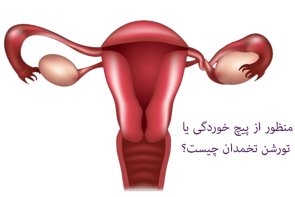 پیچ خوردگی تخمدان